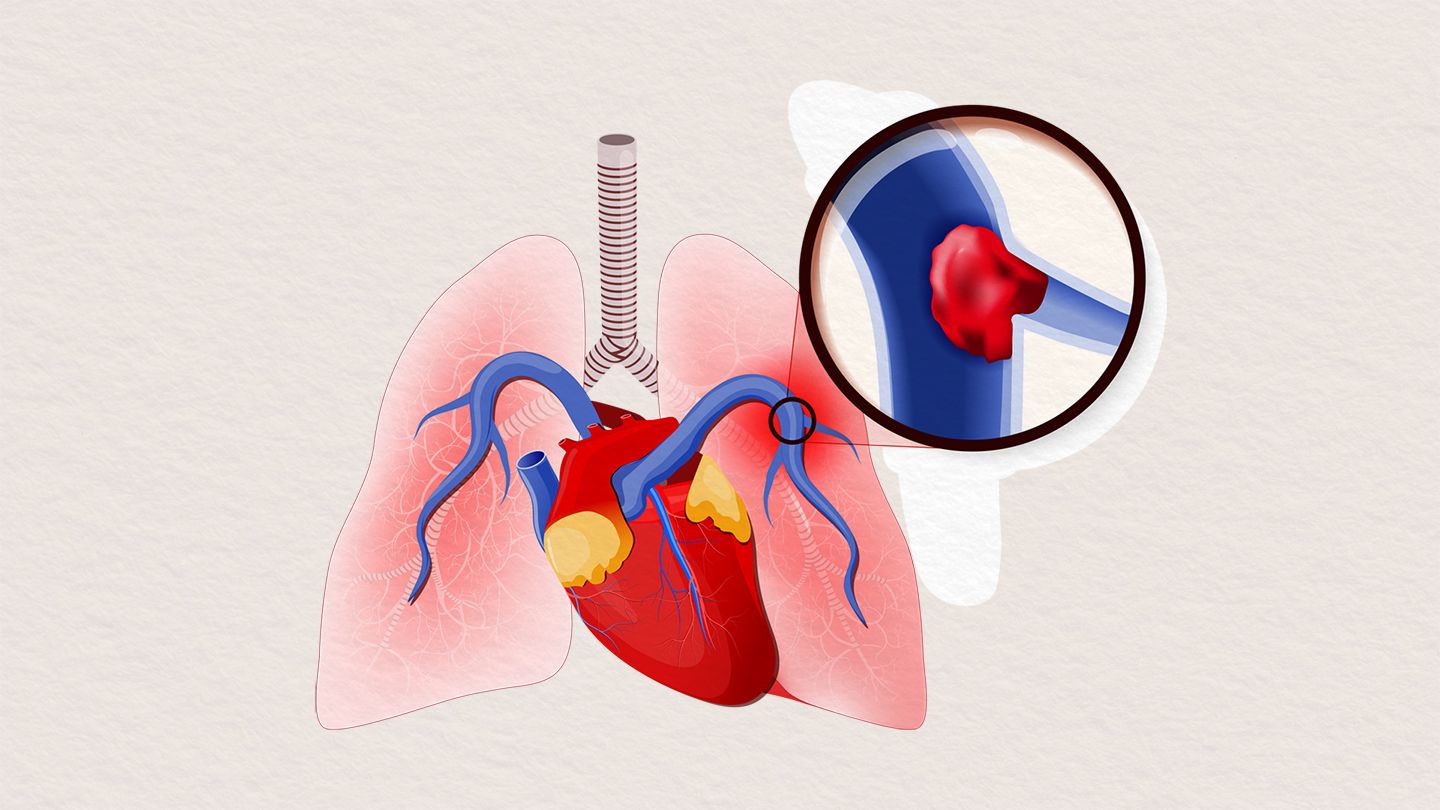 Blood clot forming inside heart