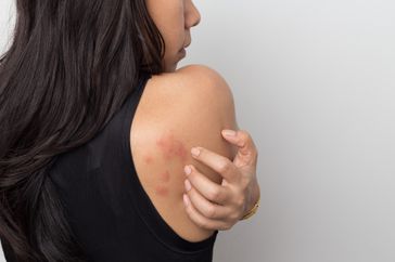 Woman with red mosquito bite marks